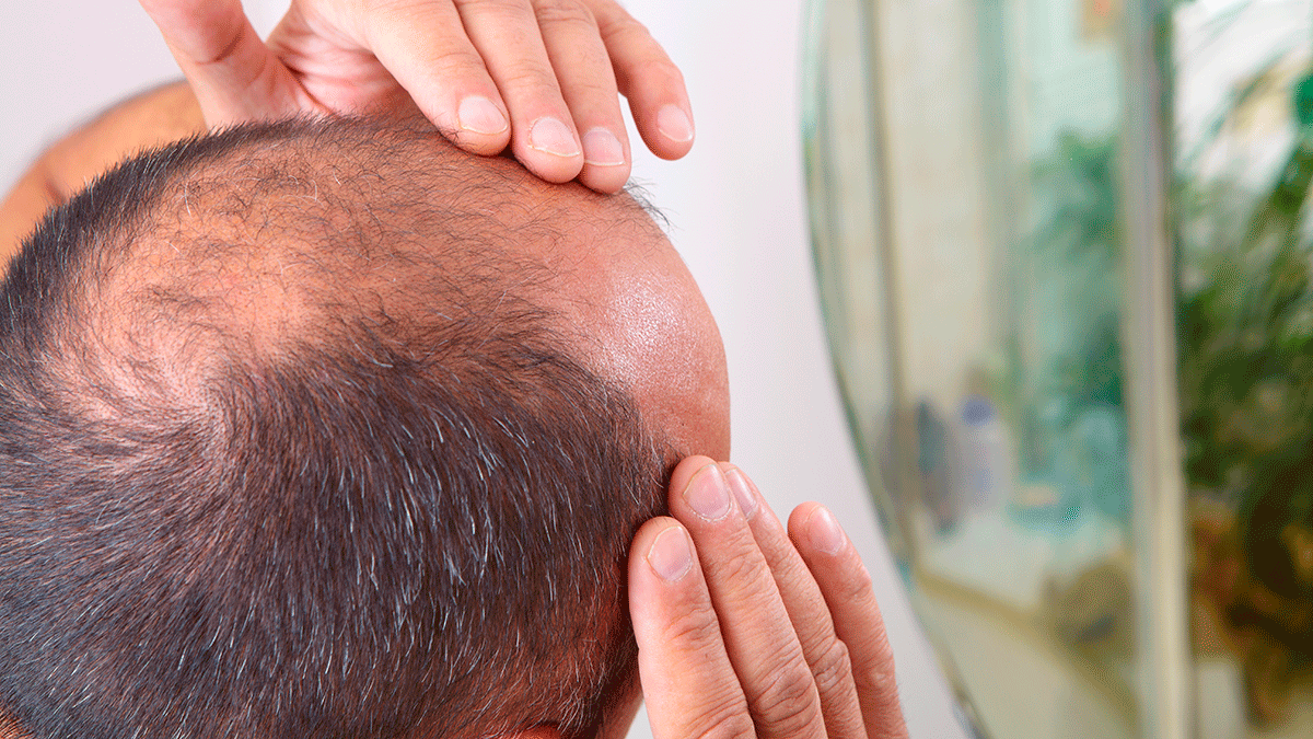 Cómo poner fin a la alopecia? Mejores capilares para frenar la calvicie Noticias en Salud